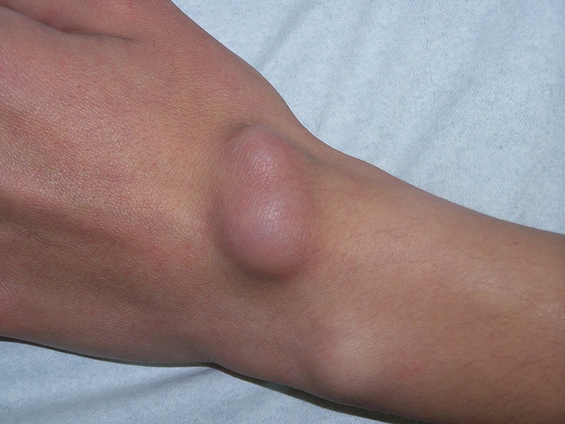 zwyrodnienie nadgarstka leczenie dureri de genunchi cum se tratează artrita