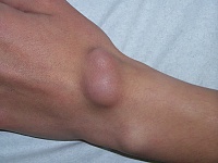 Ganglion