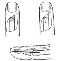 Palec młoteczkowaty