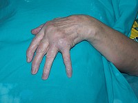 Ręka w r.z.s - przed operacją